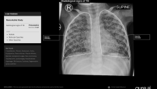 Paediatric chest X-ray scan analysis