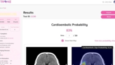 An interface of the AICute web application for the assessment of stroke risk developed by Chulalongkorn University researchers