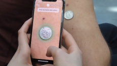 Miiskin, skin cancer