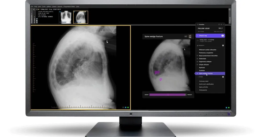 Harrison.ai's flagship product Annalise CXR